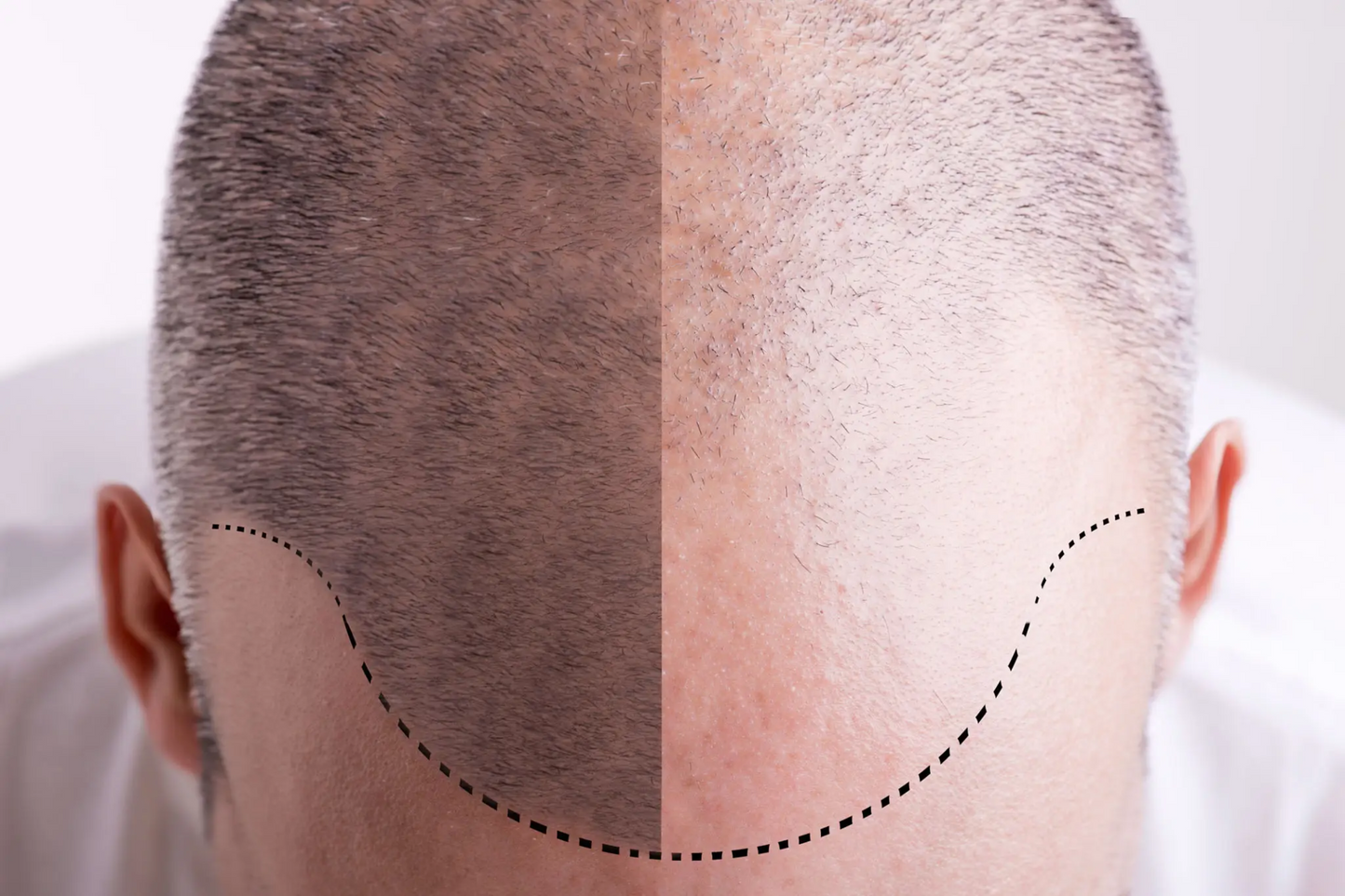 High-definition close-up comparison image showcasing dramatic before-and-after results of RootRestore’s hair regrowth treatment using finasteride, dutasteride, and minoxidil, demonstrating clinically validated effectiveness in reversing hair loss and restoring fuller, thicker hair.