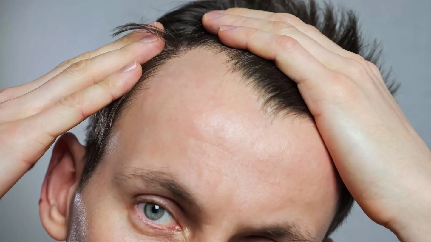 Close-up of a concerned man inspecting his receding hairline, demonstrating a common early indicator of hair loss that can be effectively reversed with RootRestore’s scientifically backed hair restoration protocol using dutasteride, finasteride, and minoxidil.