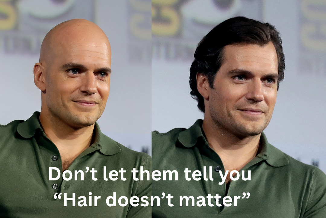 before and after of hair transplant hair loss fortify rx hair regrowth shampoo biotin nutrafol strong hair