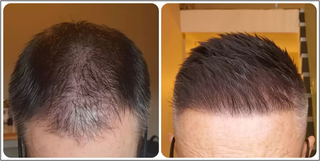 Is Oral Minoxidil Safe For Long-Term Use Against Hair Loss?