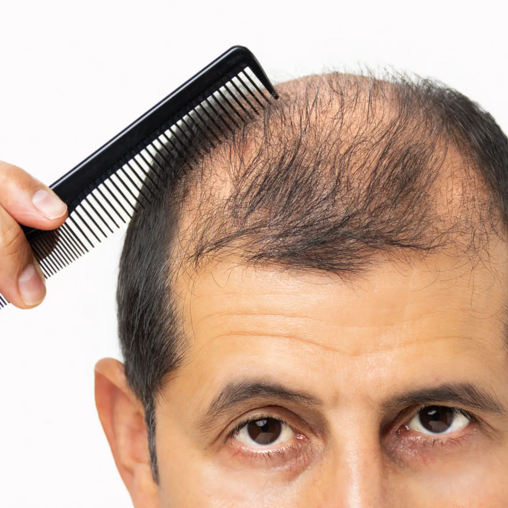 Man combing thinning hair, highlighting challenges of hair loss and the importance of advanced regrowth solutions like prescription shampoos, supplements, and treatments such as PRP and Minoxidil for effective hair restoration.