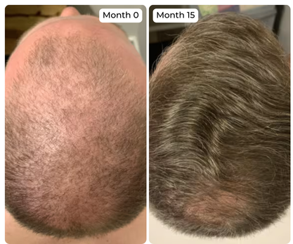 Before and after comparison of hair growth on a person's head over 15 months.