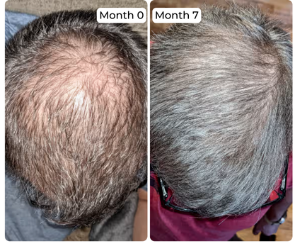 Before and after comparison of hair growth on a person's head over 7 months using hair loss solution finasteride and minoxidil.